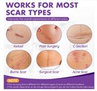 Silicone Scar Sheets   Tape Roll  3m    Scar Removal  Keloid surgery  Acne marks