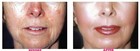 Glycolic Acid Skin Chemical Peel Kit With Skin Peel Neutralizer   Fan Brush
