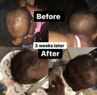 Organic Children  Baby Hair Growth Oil-cradle Cap  Scalp Eczema  Hair Growth Oil