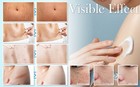 Scar Removal Cream For Stretch Marks  Surgical  Burns   Injuries Scars Removal