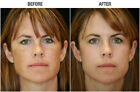 Lactic Acid Skin Peel For Acne Wrinkles Melasma Age Spots 25  40  50  90 