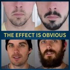 5  Minoxidil Beard Growth Oil   Derma Roller Hair Growth Serum Biotin  collagen
