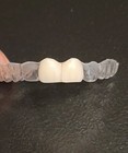 Retainers With Teeth  Affordable Way To Fill In Your Smile  With 1-3 Teeth Added