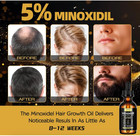 5  Minoxidil Hair Growth Serum For Men And Women  Hair Regrowth Treatment