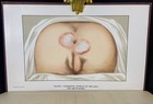 1910 Diseases Of The Rectum And Anus Antique Medical Book Color Plates Gant
