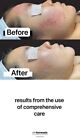 A c  Resurfacing Kit  A Set Of 4 Products For Skin With Acne