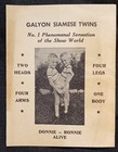 Rare 1950s Circus Sideshow Galyon Siamese Twins Donnie   Ronnie Shreveport La