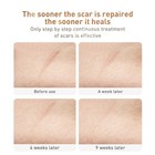 Scar And Stretch Mark Gel Remove Scars Herbal Repair Gel Face Body