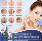 Advanced Scar Cream Silicone Scar Removal For Surgical burn stretch Marks 50ml