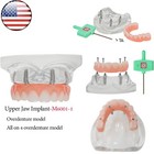 Us Dental Overdenture Implant All-on-4 Model Upper lower Jaw-clear With 4 Screws