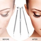 Pimple Popper Blackhead Remover Tool Kit Comedone Acne Spot Zit Extractor Tools