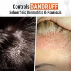 Medicasp Coal Tar Gel Dandruff Shampoo To Treat Seborrheic Dermatitis Psoriasis
