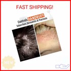 Medicasp Coal Tar Anti-dandruff Shampoo  Alleviates Symptoms From 1st Wash  Trea