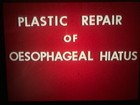 Rare 16mm Colour Medical Reel     plastic Repair Of Oesophageal Hiatus     1960s 