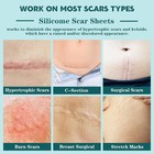 Silicone Scar Sheets  1 6  X 120  Roll- 3m silicone Scar Tape For Surgical Scars