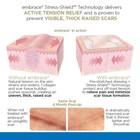 Embrace Active Scar Defense For Scars Fda-cleared Medical-grade Silicone Scar