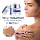 Scar Removal Cream - Rapid Repair Of New   Old Scars  Acne Spots  Burns