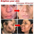 Dark Spots Removal Cream Facial Whitening Freckle Acne Mark Pigmentation Removal