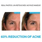 New Without Box 2 X La Roche Posay Effaclar Duo Dual Action Acne Treatment 0 7oz