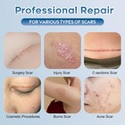 Scar Removal Advanced Cream Treatment Gel For Surgical Scars  Acne Scars