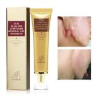 Lanbena Pimple Scar Acne Mark Spots Removal Treatment Gel Ointment Blemish Cream