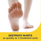 Quemar Verrugas Remedio Para Quitar Mezquinos Quitador De Verrugas Wart Remove