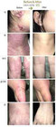 One Isal Atopy Eczema Cream Lotion  made In Usa