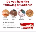 Flowbow Wart Remover Cream remove Common Warts  Skin Tags     Corns 