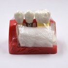 Dental Implant Analysis Crown Bridge Demonstration Teeth Study Model Typodont