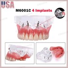 Us Dental Model Removable Overdenture Teeth Upper lower Jaw 4 Implants Model