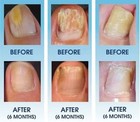 Nail Fun-gal Lacquer 2 5ml Free   Fast Delivery