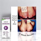 Psoriasis Clinically Proven  Dermatologist Developed Skin Clearing Natural Mi   
