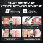 Titanium Alloy Ingrown Toenail Treatment  Nail Tools  And Ingrown 0 59 0 67in