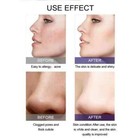 Glycolic Acid 20  Pads Peel Wrinkles Acne Scars Melasma Age Spots 60 Ct 