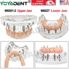 Us Dental Teeth Model Overdenture Inferior Implants Demo Upper lower Detachable