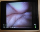 Verathon Avl 0570-0338 Glidescope Video Laryngoscope Monitor W power Supply