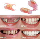 Tooth Repair Kits Diy For Making Temporary Partial Or Full Dentures tooth Fixing