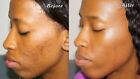 Skin Whitening Dark Spots Lightening Acne Brightening Turmeric Honey Kojic Acid