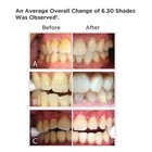 Ibrite Automix Chairside Teeth Whitening System 1 5-patient Kit Gel-type