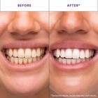 Hismile V34 Whitening Strips  Teeth Whiteningstrips  Purple Tooth Whitening