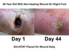 Silvrstat Antibacterial Wound Dressing Gel   Abl Med    factory Direct 