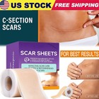 Silicone Scar Sheets  1 6  X 120  Roll- 3m  Silicone Scar Tape For Surgical Scar