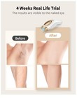 Laser Hair Removal Device