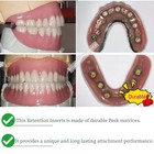 Dental Novaloc Retention Inserts Cap Novaloc Processing Package Peek Overdenture