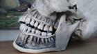 1800s Antique Mounted Medical Anatomical  Real  Human Skull Model  Teeth
