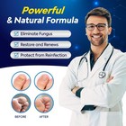 Toenail Fungus Treatment Extra Strength With 25  Undecylenic Acid