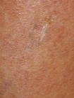 Dr  Ettmuller s Morgellons Parasite Detectant   Biofilm Exfoliant Itch Relief