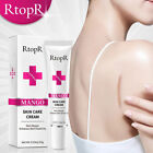 15g Fade Scar Stretch Marks Remover Cream Skin Repair Face Cream Acne Spots