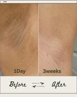 Hydroquinone Lotion 3  Skin Whitening Treat Dark Spots Melasma Hyperpigmentation