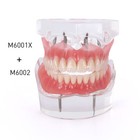 Dental Implant Teeth Model Demo Overdenture Restoration With 2 4 Implants U l
